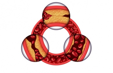 Le cholestérol chez la femme : comment le réduire ?