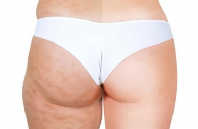 Les 6 aliments qui produisent de la cellulite