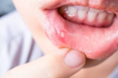 7 remèdes naturels pour soigner les aphtes
