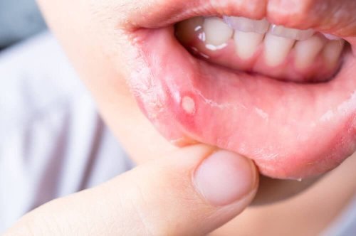 7 remèdes naturels pour soigner les aphtes