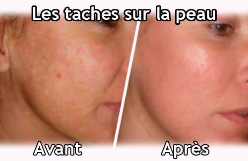 taches peau