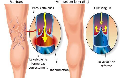 varices