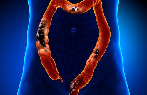 Les aliments que l’on doit éviter quand on souffre de diverticulose Les aliments que l’on doit éviter quand on souffre de diverticulose