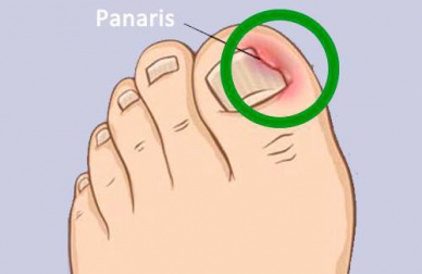 Comment soigner les panaris naturellement ?