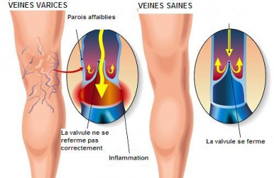 Des exercices utiles pour les varices