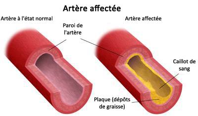 artériosclérose et maladies cardiaques chez la femme