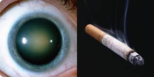 Le tabagisme participe au développement de la cataracte.