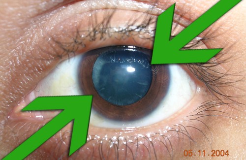 Lutter contre la cataracte : traitement et prévention