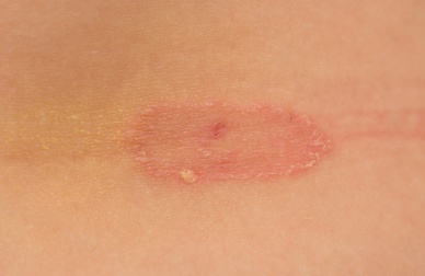 Comment prévenir l’apparition des champignons sur la peau ?