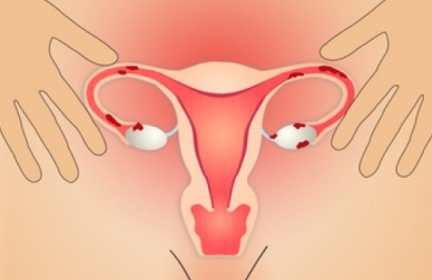 Les causes et les remèdes pour l'endométriose
