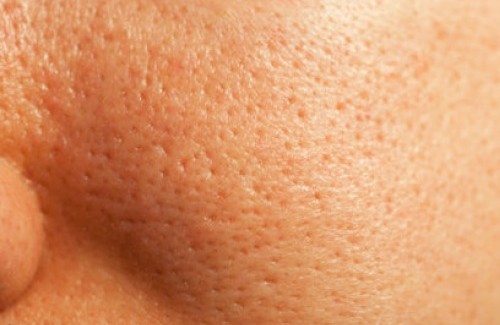 Pores dilatés : causes et traitements