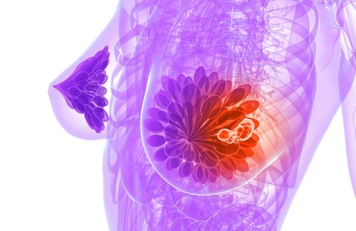 Comment détecter à temps un cancer du sein ? Comment détecter à temps un cancer du sein ?