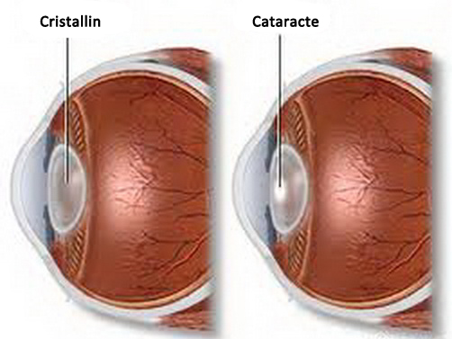 Vue de profil d'un œil atteint de la cataracte.