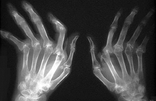 Soigner l'arthrite : 10 remèdes naturels à connaître
