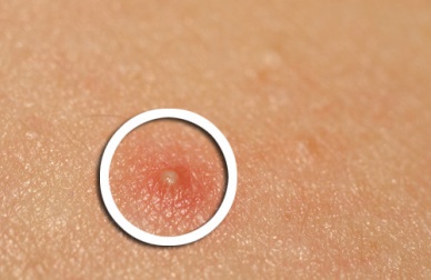 Remède au thé vert contre l'acné