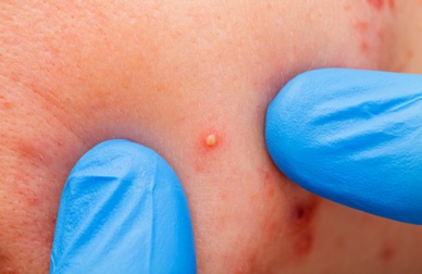 Pourquoi avons-nous des boutons et comment les prévenir ?