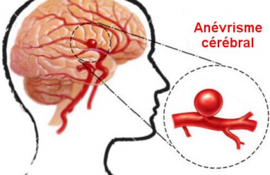 Qu'est-ce qu'une rupture d'anévrisme et comment la prévenir ?