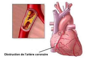 8 mauvaises habitudes qui peuvent générer des problèmes cardiaques
