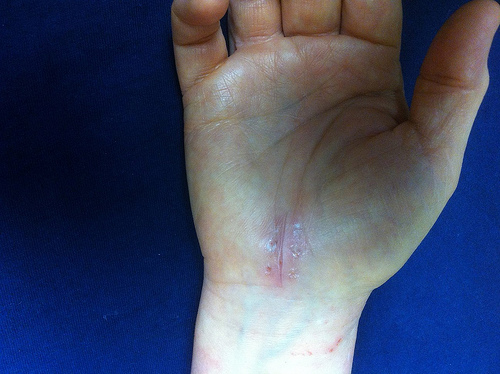 Cicatrice sur la main 