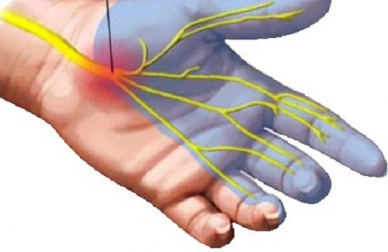 Des solutions naturelles au syndrome du canal carpien