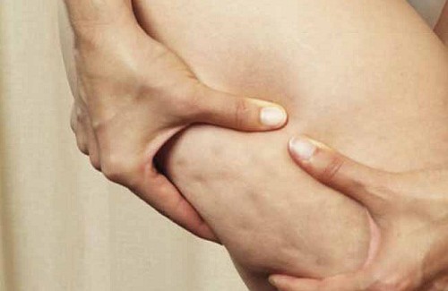 Conseils simples pour éliminer la cellulite
