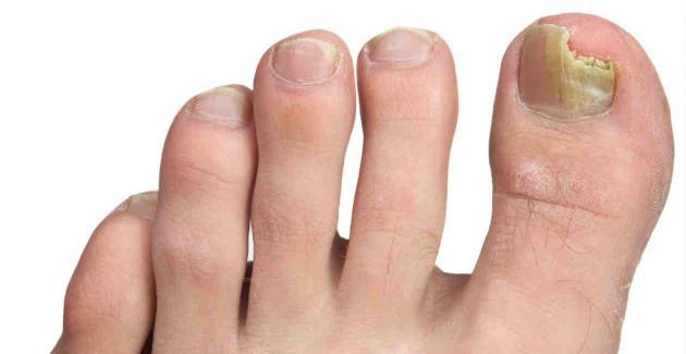 Comment prévenir les mycoses des ongles de pieds ?