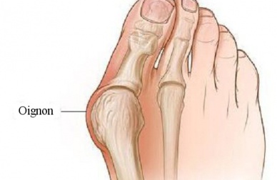 Comment se forment les oignons de pied