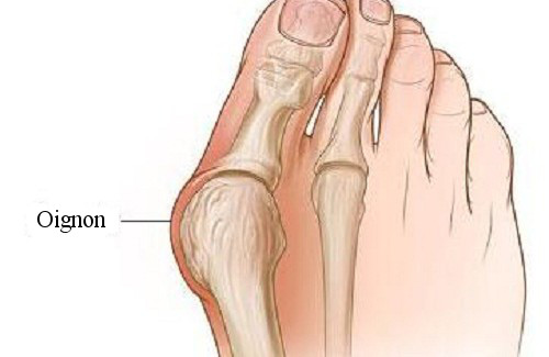 Comment se forment les oignons de pieds Comment se forment les oignons de pieds