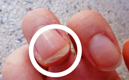 dédoublement des ongles, une des principales maladies des ongles