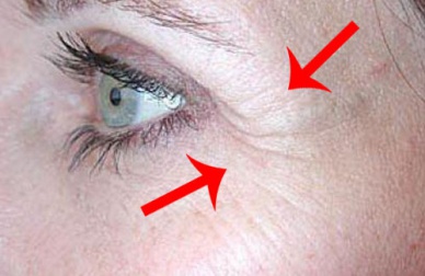 Causes et remèdes pour les pattes-d'oie