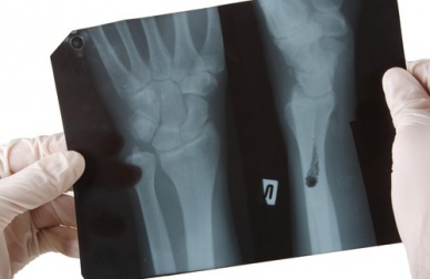 Les aliments qui affectent la santé des os