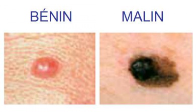 Tout savoir sur le grain de beauté