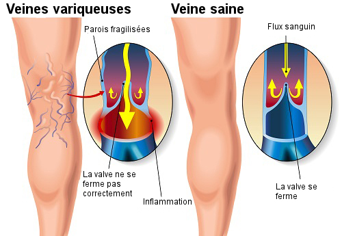 Comment traiter les varices ?