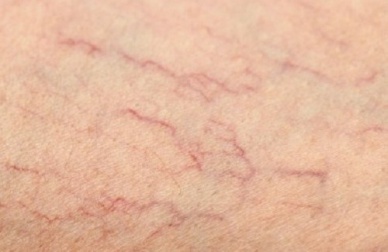 Remèdes contre les varicosités sur les jambes