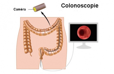 Comment détecter le cancer du côlon à temps