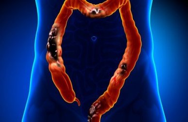 Les aliments que l'on doit éviter quand on souffre de diverticulose