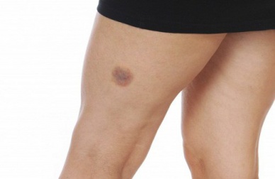 Comment soigner les bleus?