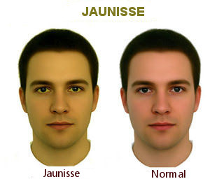 La jaunisse est une cause du foie intoxiqué.