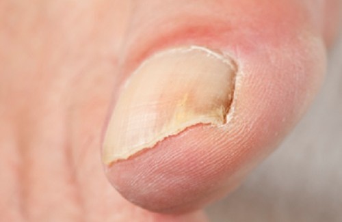 Traitement des principales maladies des ongles