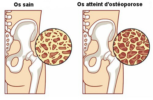 8 aliments pour prévenir l’ostéoporose