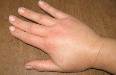 Des infusions pour traiter la rétention d'eau