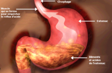 Un régime alimentaire équilibré pour les personnes souffrant de reflux