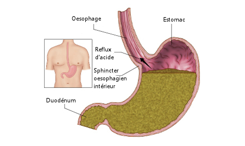 Les reflux sont des signes du foie intoxiqué.