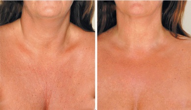 Remède pour atténuer les rides du cou