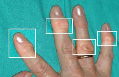 Remèdes naturels pour traiter l'arthrite