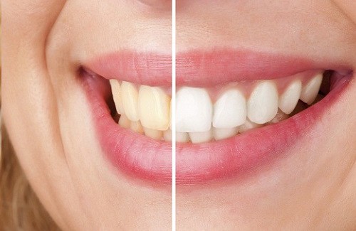 5 astuces naturelles qui font blanchir les dents