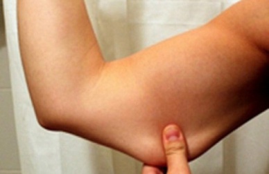 Bras et jambes flasques: que faire?