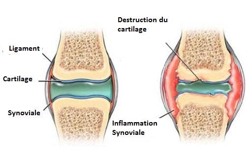 Comment prévenir les douleurs au niveau du cartilage