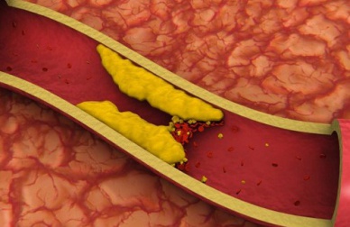 Des jus pour réduire votre taux de cholestérol
