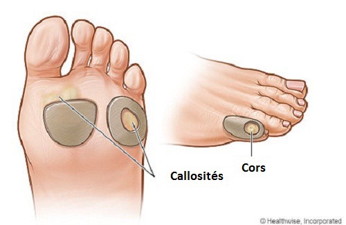 Le lait au sel pour des pieds doux et sans cors : chaussures serrées